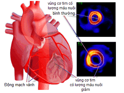 Xạ hình tưới máu cơ tim Myocardial Perfusion Scan
