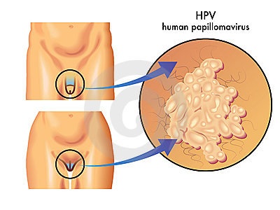 HPV và vacxin chống virus HPV