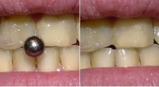 Mẻ răng ở một trường hợp đeo khuyên lưỡi