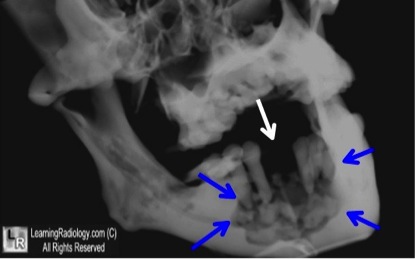 Hoại tử xương hàm do dùng thuốc Biphosphonate phát hiện trên phim X Quang
