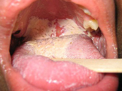 Nhiễm nấm Candida ở miệng