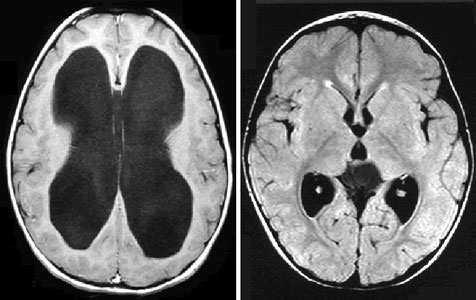Não úng thủy - Tích tụ dịch não trong hộp sọ