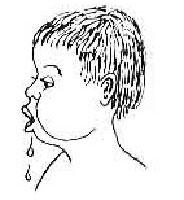 Nhỏ nước dãi ở trẻ bị tật khe hở môi hàm