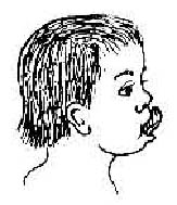 Tập môi lưỡi mạnh hơn ở trẻ bị tật khe hở môi hàm