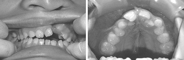 Chăm sóc răng ở trẻ bị tật khe hở môi hàm