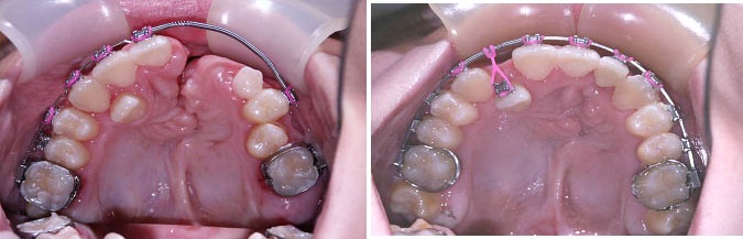 Chỉnh răng của trẻ bị tật khe hở môi hàm