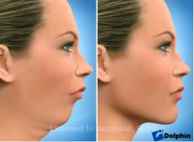 Kết quả khuôn mặt nhìn nghiêng trước và sau khi phẫu thuật chỉnh hình.