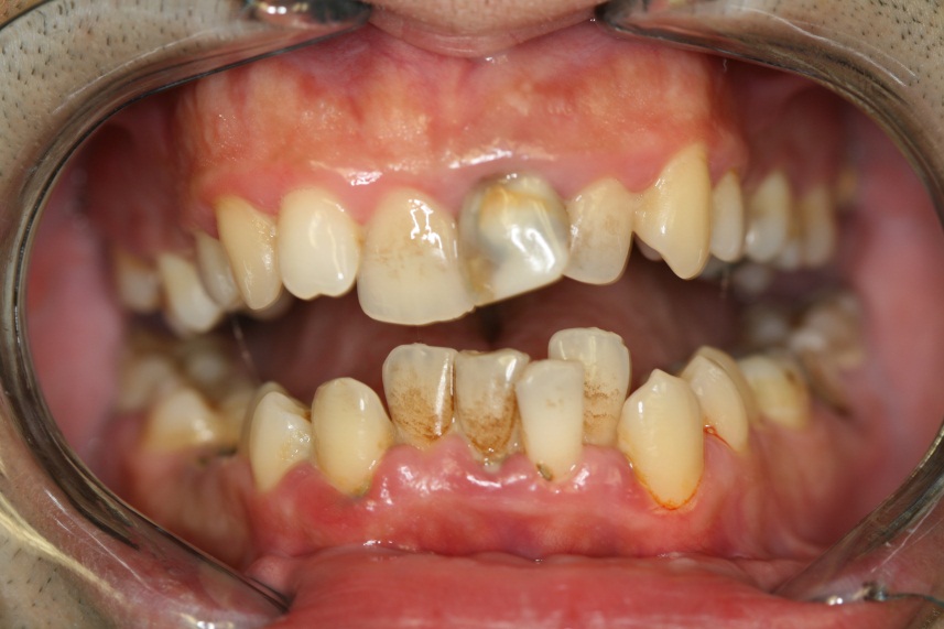 Có nhiều nguyên nhân dẫn đến đổi màu răng