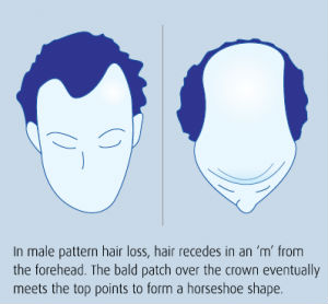 Hình ảnh rụng tóc ở nam giới