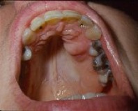 U men ngoại biên nằm ở nướu răng mặt trong xương hàm trên vùng răng trước trái