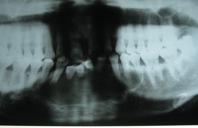 U men gây phồng ngách lợi hàm dưới vùng cằm, tiêu ngót chân răng.