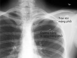 X quang tràn khí màng phổi