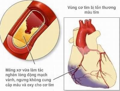 Nhồi máu cơ tim (cơn đau tim) 1