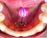 Khuyên lưỡi gây tụt nướu răng hàm dưới mặt trong (mũi tên)