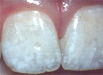 Răng bị nhiễm Fluor