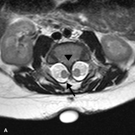 Hình MRI cột sống của một bé sơ sinh: Hình T2W cắt ngang (A) cho thấy tủy sống chia đôi (Diastematomyelia) với hình ảnh tủy sống chia thành hai nửa bởi vách xương (mũi tên đen)