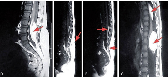 Hình MRI cột sống của nhiều bé khác nhau cho thấy u mỡ cùng cụt (hình D), dò xoang bì (hình E), u mỡ dây tận (hình F), nhiều u mỡ trong tuỷ sống (hình G).
