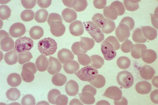 Bệnh sốt rét (Malaria) - Y Học Cộng Đồng