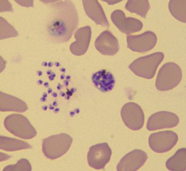 hồng cầu chứa ký sinh trùng Plasmodium