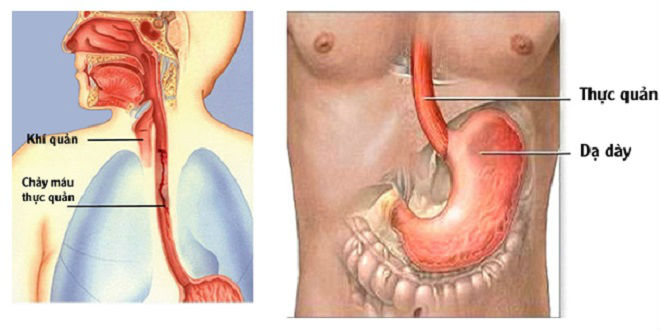 Giãn tĩnh mạch thực quản