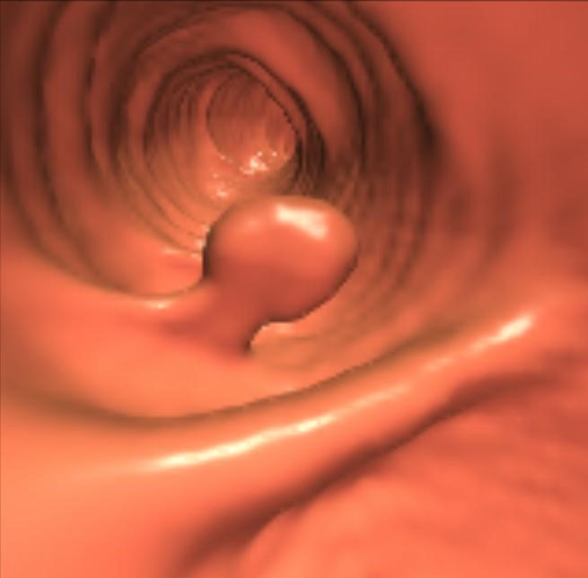 Polyp đại tràng được phát hiện qua CT đại tràng