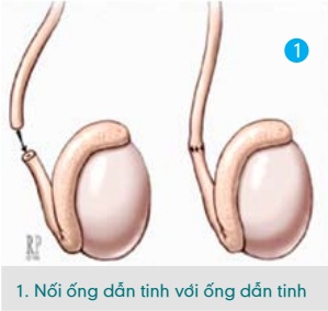 Nối ống dẫn tinh với ống dẫn tinh