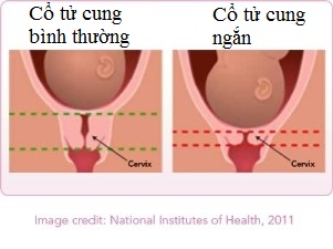 Cổ tử cung ngắn