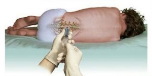 Vì sao bé cần lấy nước vùng thắt lưng