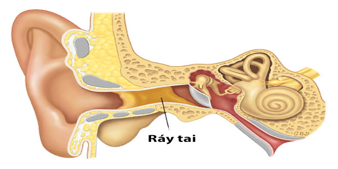 Có cần phải lấy ráy tai - Bít tắc tai do ráy tai