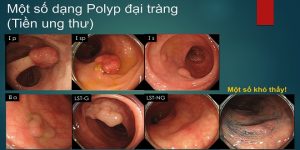 ung thư biết sớm trị lành 5