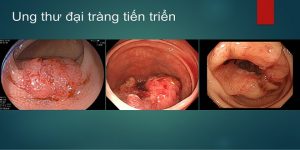 ung thư biết sớm trị lành 6