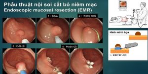 ung thư biết sớm trị lành 8