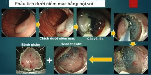ung thu biet som tri lanh 10