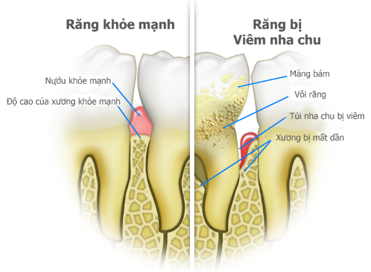 Ảnh hưởng của bệnh nha chu đối với các tổ chức quanh răng