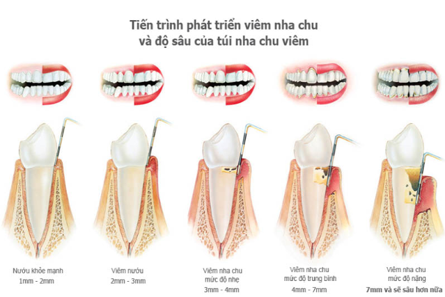 Các giai đoạn tiến triển của bệnh viêm nha chu