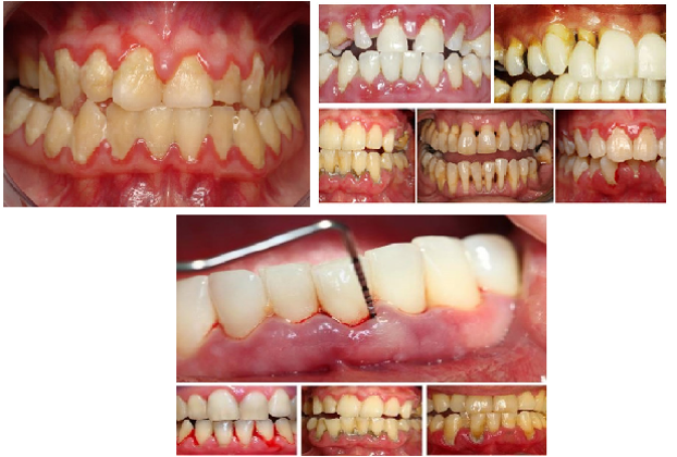 Các hình ảnh về bệnh viêm nha chu