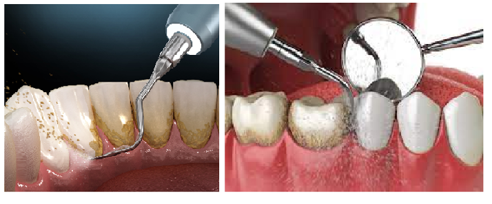 Cạo vôi răng định kỳ.