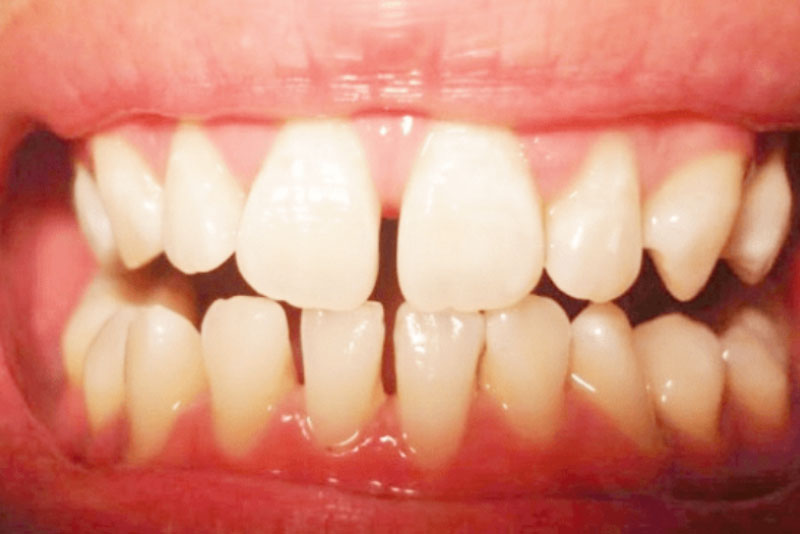 Bệnh lý nha chu: Phòng bệnh hơn chữa bệnh