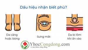 Phù ở bệnh nhân tiểu đường