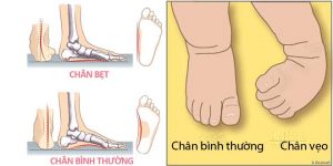 bàn chân vẹo, bàn chân bẹt