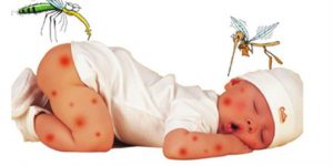 Phân biệt sốt xuất huyết và sốt phát ban 