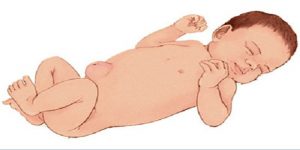 Rốn lồi - Thoát vị rốn
