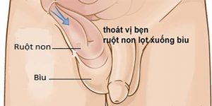 Thoát vị bẹn ở trẻ em