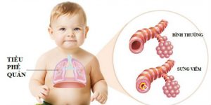 Viêm tiểu phế quản co thắt ở trẻ 