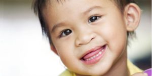 Tật sức môi chẻ vòm (Hở hàm ếch)