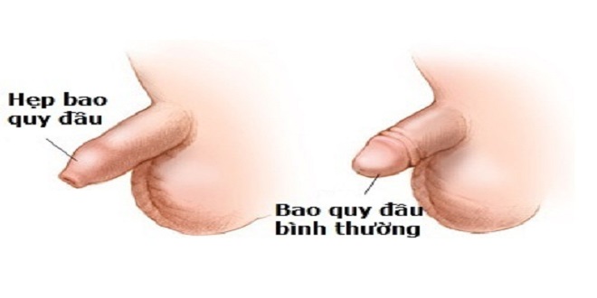 Hẹp bao quy đầu ở trẻ em