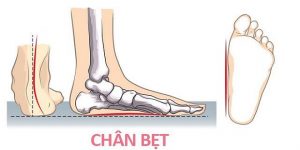 bàn chân bẹt