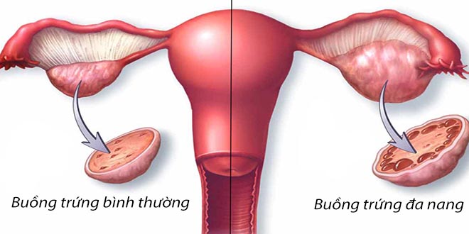 Buồng trứng đa nang