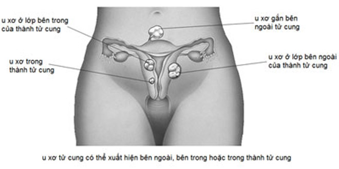 U xơ cơ tử cung