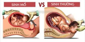 Sinh thường sau mổ lấy thai
